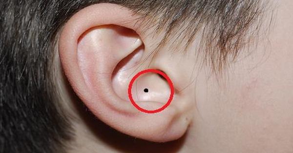 nốt ruồi vành tai