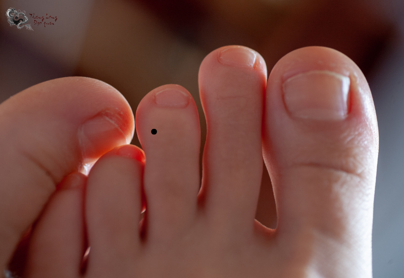 Nốt ruồi ở ngón chân giữa thường mang điềm báo không tốt